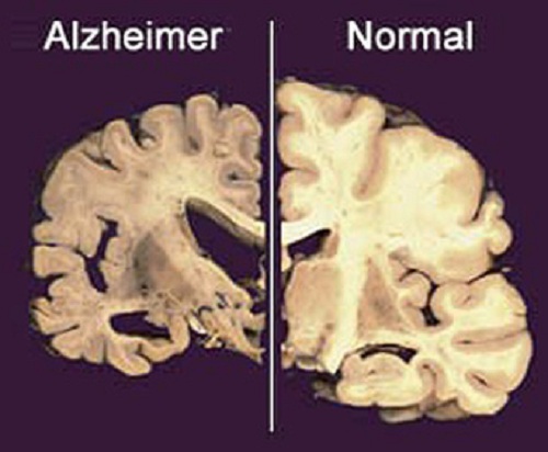 Cérebro de uma pessoa normal e uma pessoa com doença de Alzheimer